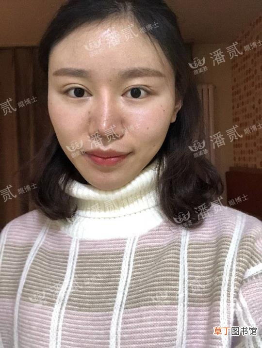 眼角增生是什么样子 开眼角要多久恢复