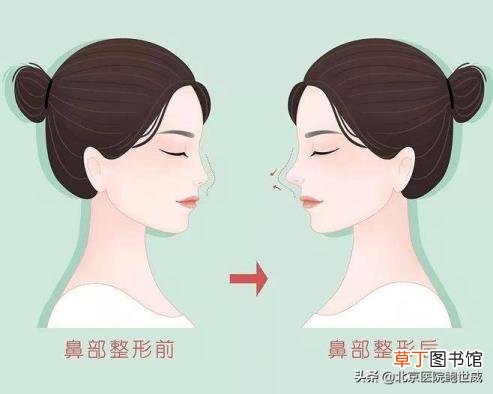隆鼻拆线后冰敷多久 隆鼻冰敷多久