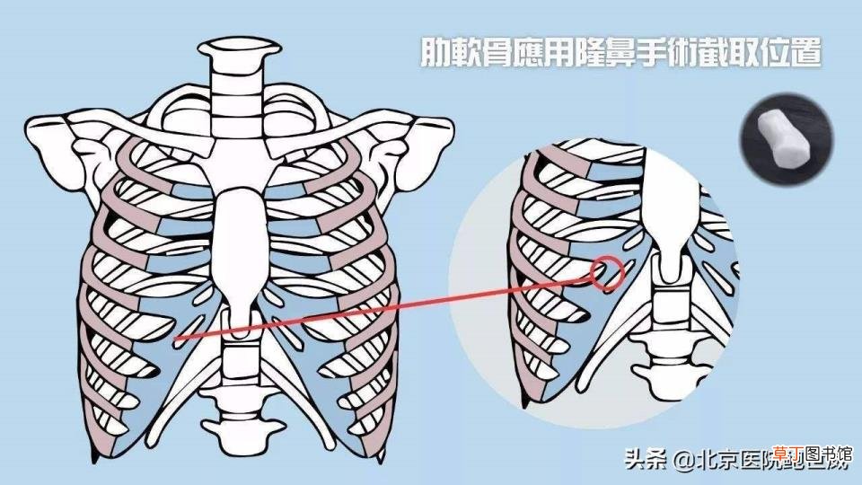 隆鼻拆线后冰敷多久 隆鼻冰敷多久