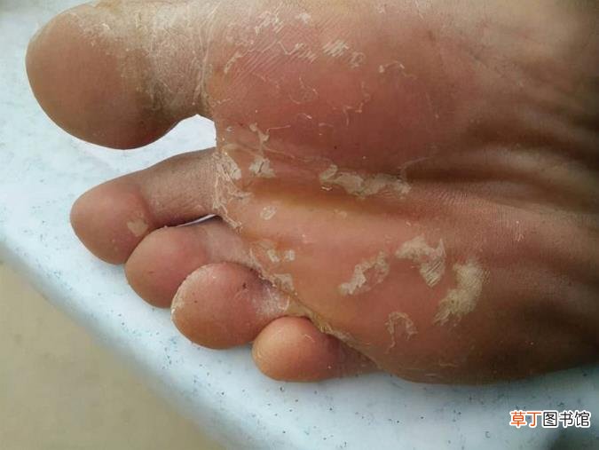 脚底有些破皮 为什么脚破皮