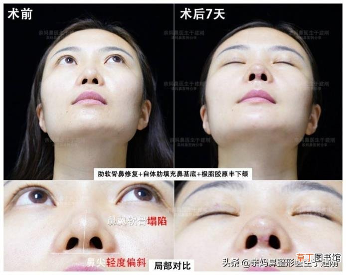 做的肋骨鼻第9天都我我鼻子是歪的 为什么我的鼻子歪的