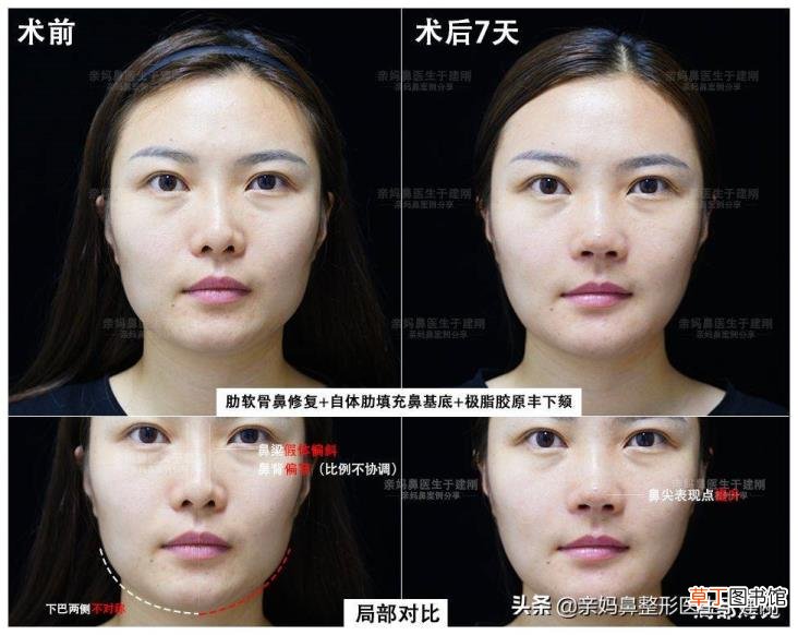 做的肋骨鼻第9天都我我鼻子是歪的 为什么我的鼻子歪的
