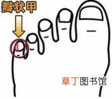 小脚趾甲两瓣遗传规律 为什么小脚趾甲两瓣