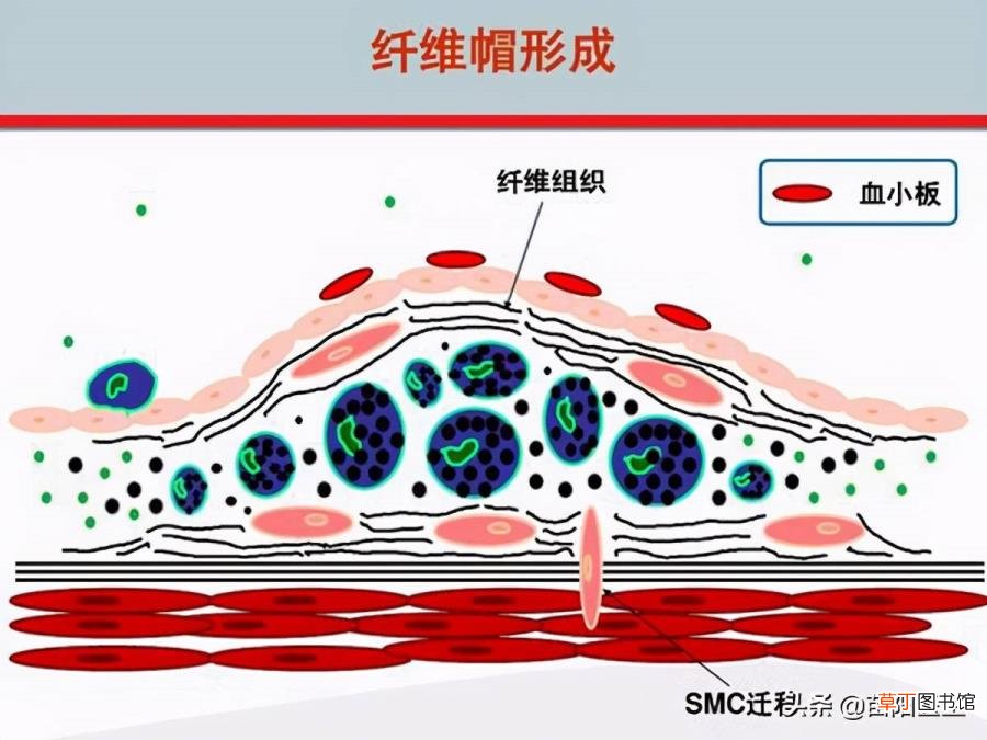 40岁动脉硬化能活多久 血管为什么会破裂