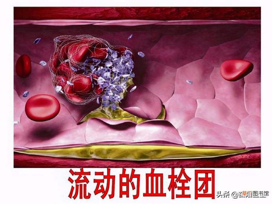 40岁动脉硬化能活多久 血管为什么会破裂