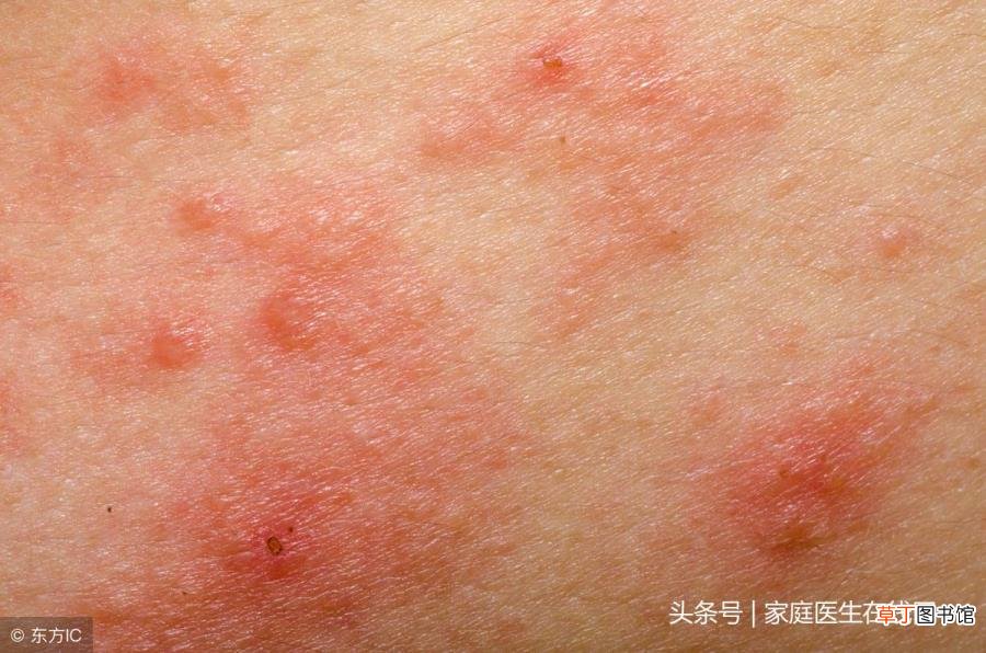 婴儿湿疹是母体带来的吗 为什么婴儿有湿疹
