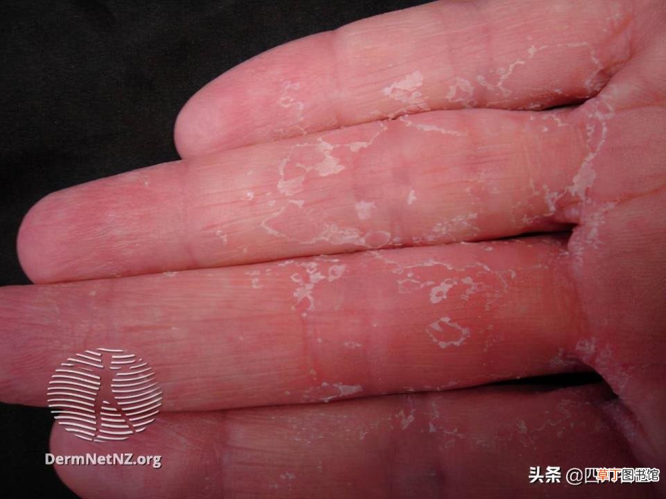 手脱皮是什么病的预兆 手为什么老是脱皮