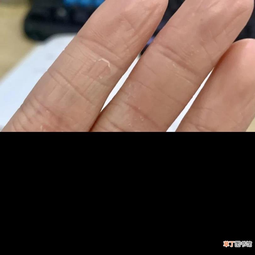 手脱皮是什么病的预兆 手为什么老是脱皮