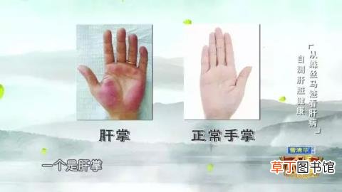 手上长血红色的点是为什么? 手上为什么长斑