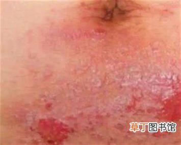 湿疹为什么会渗水 湿疹为什么会脱皮