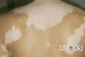起白斑是什么病 为什么得白癜风