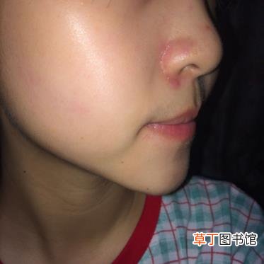 鼻头长痘红肿快速消除 鼻子长痘是为什么