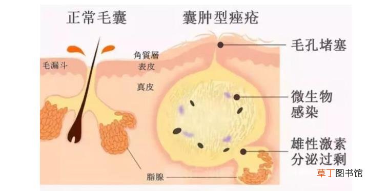 脸上最近一直长痘痘 为什么最近脸上长痘