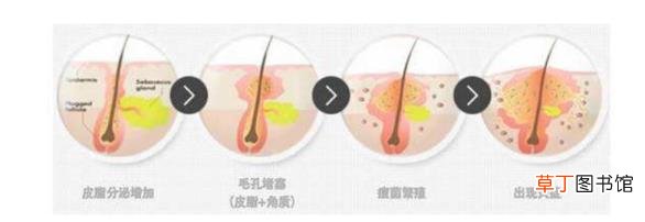 脸上最近一直长痘痘 为什么最近脸上长痘