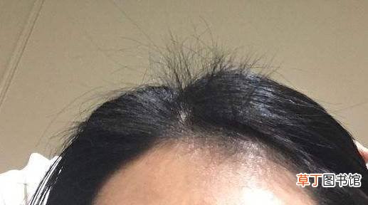 小窍门解决头顶碎发都有哪些