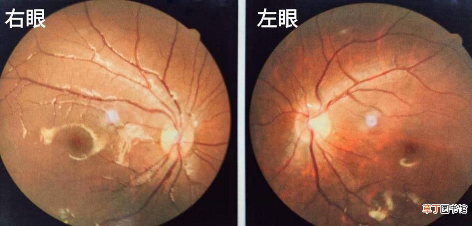 眼睛为什么会近视? 为什么一只眼睛近视