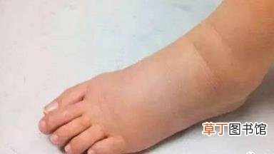 脚肿了怎么快速消肿 为什么脚腕肿