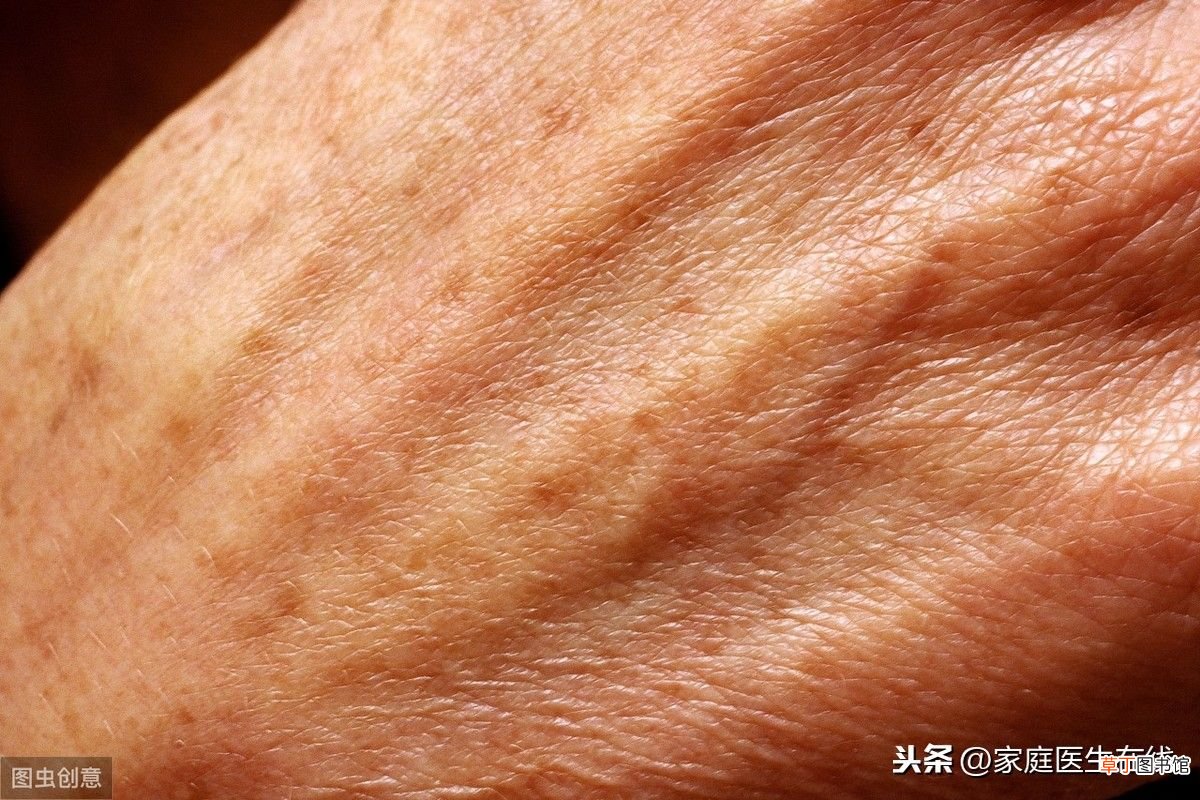 一般几岁开始长老年斑？ 多大年龄长老年斑