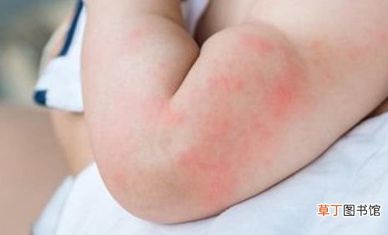 荨麻疹影响生活工作 荨麻疹的治疗方法