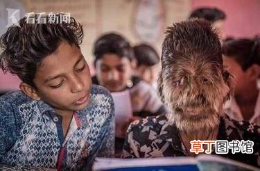 小孩子脸上长毛是怎么回事 为什么脸上长汗毛