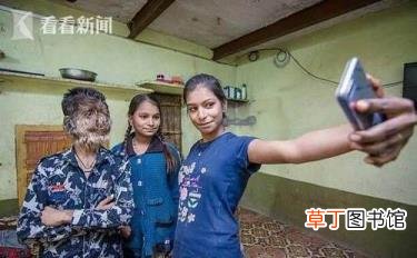 小孩子脸上长毛是怎么回事 为什么脸上长汗毛