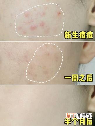 欧慕慕真的能祛痘吗