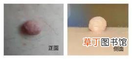 寻常疣裂开好多肉芽 为什么会长肉芽