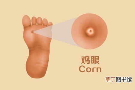为什么突然长了好几个鸡眼 为什么会起鸡眼