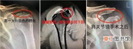 肩膀忽然疼得受不了 为什么肩膀突然很痛
