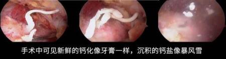 肩膀忽然疼得受不了 为什么肩膀突然很痛