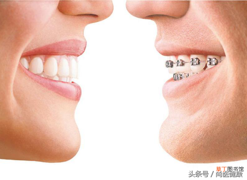 牙齿矫正对脸型到底有没有影响？ 牙齿矫正与脸型