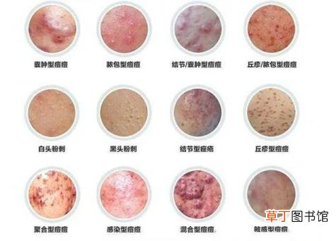 痘痘长在皮肤里成硬块 痘痘为什么会疼