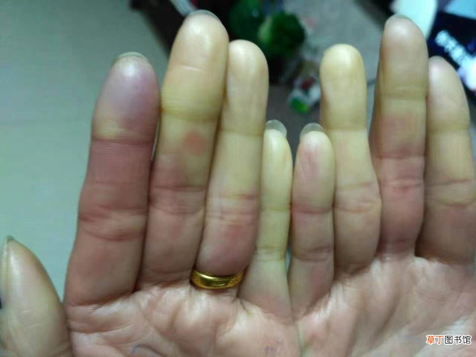 手指纹里面黑黑的洗不掉 手为什么会黑