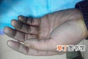 手指纹里面黑黑的洗不掉 手为什么会黑