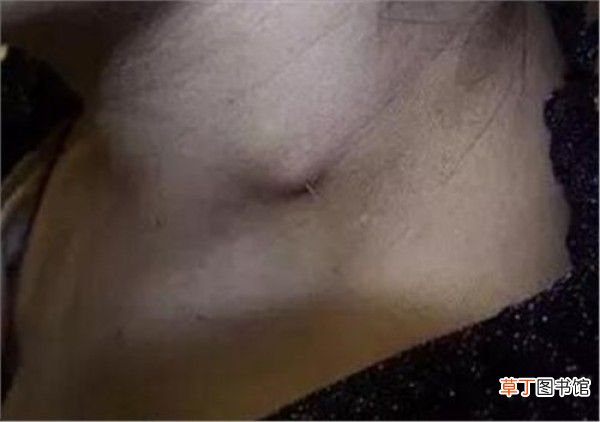 鱼刺卡住喉咙的急救方法 鱼刺卡喉怎么办