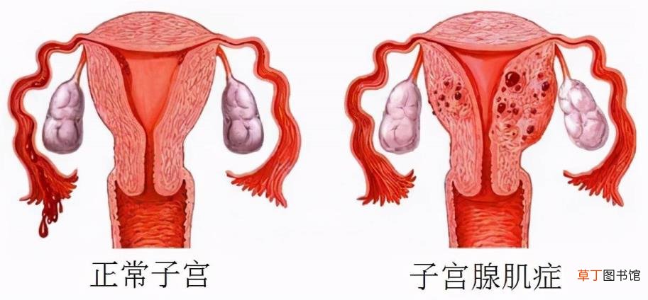 子宫摸着有个硬硬的小疙瘩 为什么下面会硬