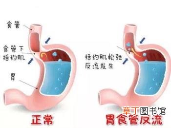 为什么会出现胃食管反流 为什么胃反流