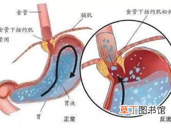 为什么会出现胃食管反流 为什么胃反流