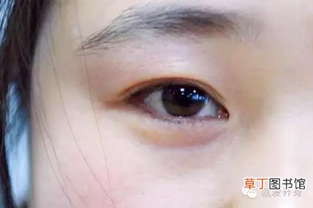 黑眼圈是什么病的征兆 为什么总有黑眼圈