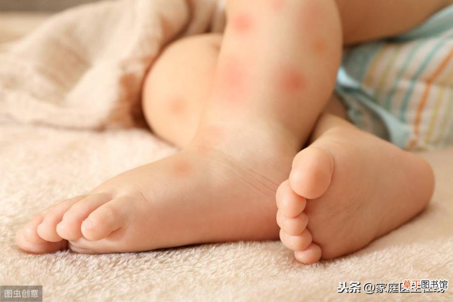 宝宝捂出来的湿疹怎么处理 宝宝为什么会出湿疹