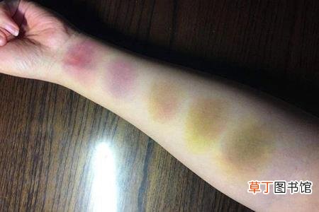 洗热水澡会加重淤青吗 为什么会淤青