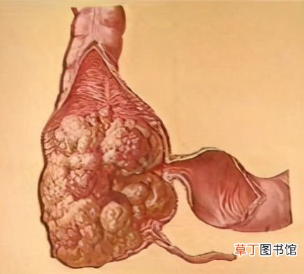 拉不出便便怎么办？ 大便拉不出来怎么办