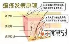 毛孔栓塞物怎么形成的 为什么毛孔会堵塞