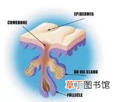 毛孔栓塞物怎么形成的 为什么毛孔会堵塞