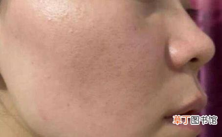 脸上突然长很多痘痘 为什么老长粉刺痘痘