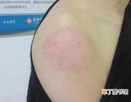 白斑处变红是好转吗 为什么长白癜风
