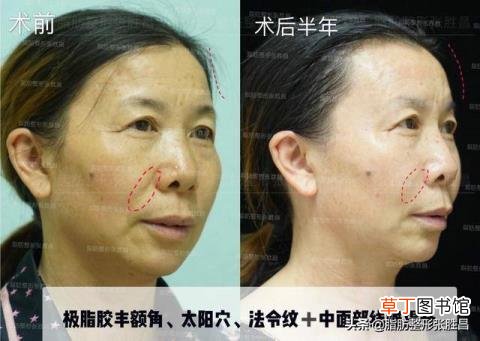 为什么年纪很小法令纹很深 年轻为什么有法令纹