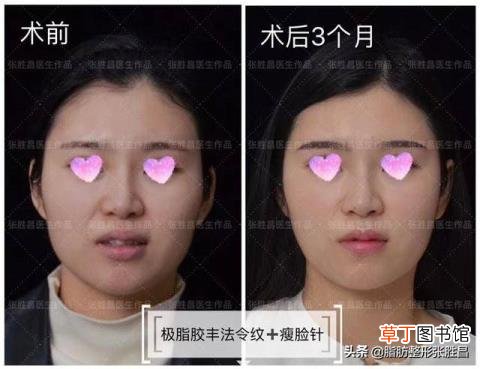 为什么年纪很小法令纹很深 年轻为什么有法令纹