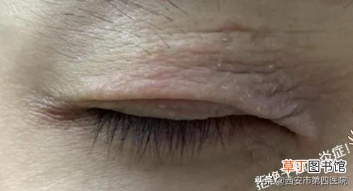 眼皮突然松弛 眼皮为什么会松