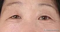 眼皮突然松弛 眼皮为什么会松